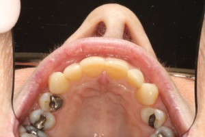 toothwearocclusalview