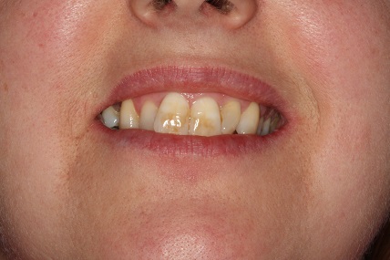 Discoloured incisors