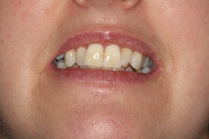 After tooth whitening