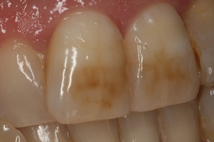 Discoloured central incisors
