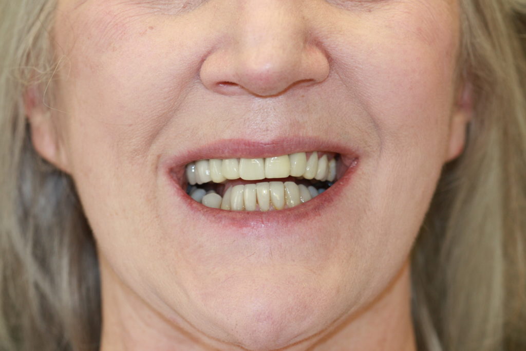 edges of upper front teeth not following lower lip line