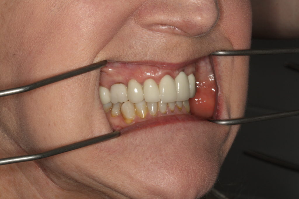 side view of final porcelain crowns